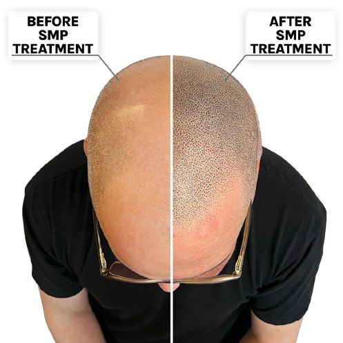 Thinning Hair Treatment